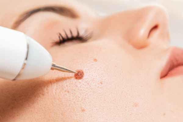 CryoPen: 5 Skin Concerns It May Be Used to Treat 3 What actually happens during a CryoPen treatment Brislington?