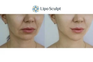 Explaining Total Skin Tightening Treatment And What It Can Do For You 2 Do you want to boost your self confidence? Give Morpheus8 Brislington a try today!