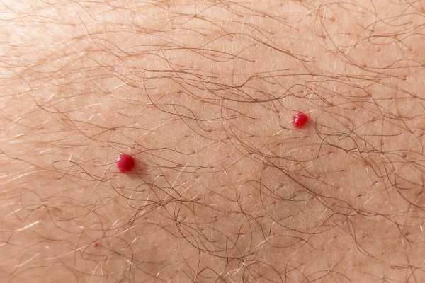 CryoPen: 5 Skin Concerns It May Be Used to Treat 2 cherry angioma removal Brislington