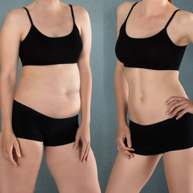 Does Fat Freezing at Home Work? DIY Devices vs Professional Cryolipolysis 2 before and after Cryolipolysis Brislington