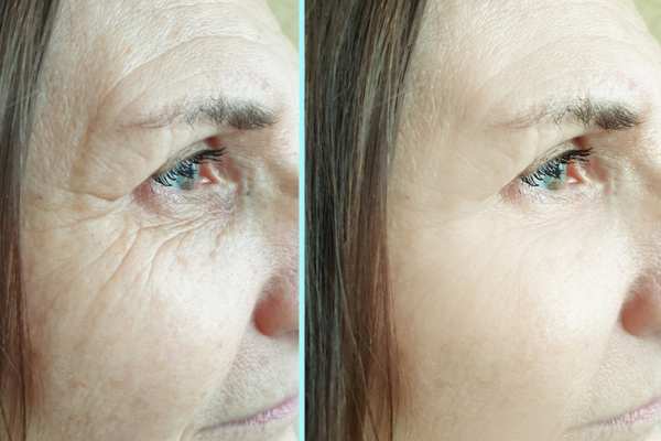 Why Do People Choose HIFU for a Non-Surgical Facelift? 4 How long can HIFU results last Brislington?