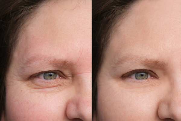 HIFU vs Botulinum Toxin: Understanding the Differences 4 How long do HIFU results last Brislington?